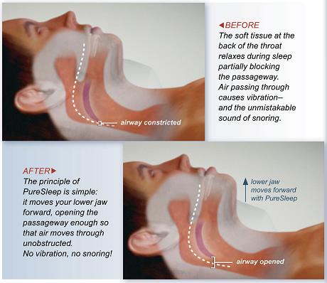 PureSleep2 What's going on when you snore
